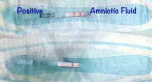 amniotic fluid leak on pad