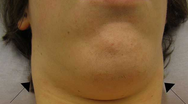 Lump Under Chin Causes Right Or Left Side Near Throat Neck