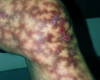 mottled before rash