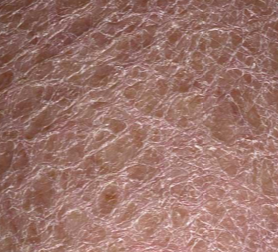 Dry Skin on Legs Looks Like Scales