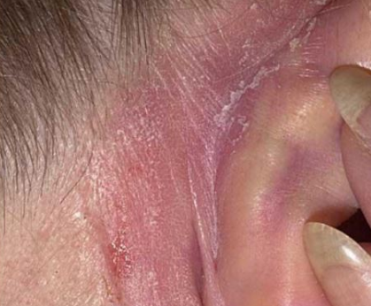 Flaky Dry Skin behind Ears