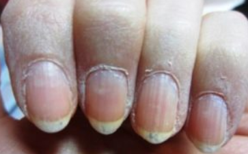 How to Fix Dry Skin around Nails