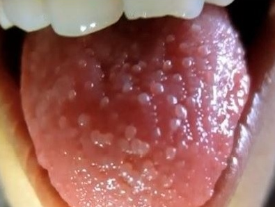 Inflamed Taste Buds Picture