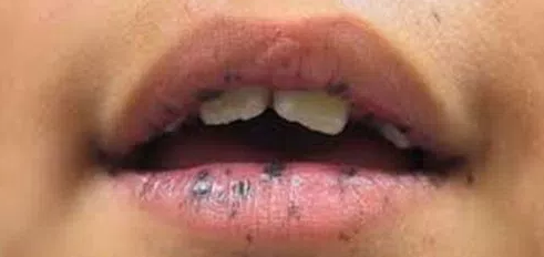 Picture of Black Spots on Lips
