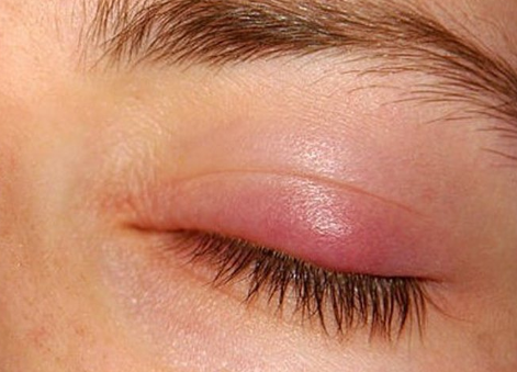 how to treat a stye on eyelid