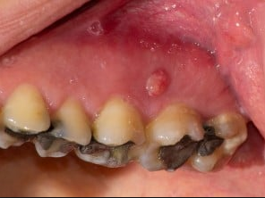 Pimple on Gums