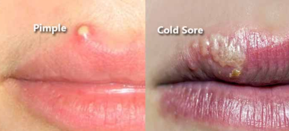 Remedies pimple line on lip home Best Treatments