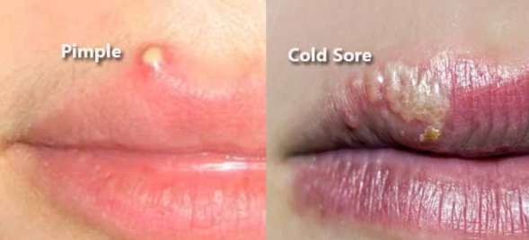 Pimple or Cold Sore on Lips - Differences