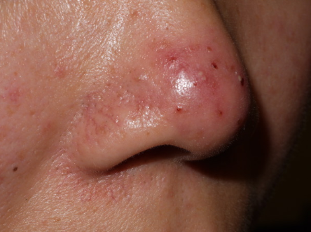 Red Spots on Nose