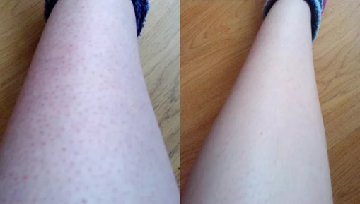 Strawberry Legs Before and After Picture