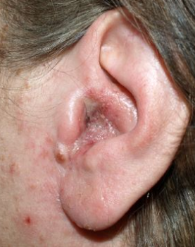 Swelling in the Ear Canal