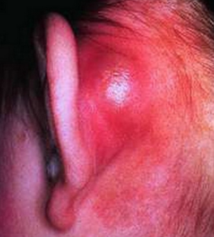 Swollen Ear Lobe could be Mastoiditis Picture