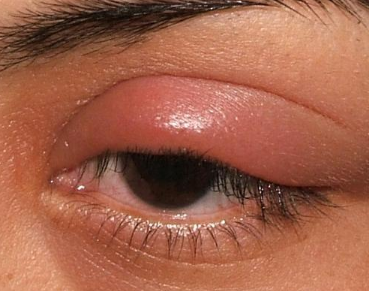 Swollen Eyelid