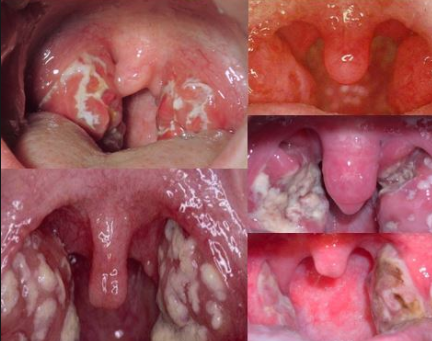 White Spots on Tonsils Picture