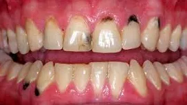 Black spots on gums near tooth