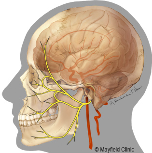 Hemifacial Spasm