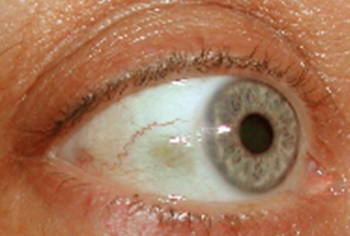 Bump on Eyeball Pictures