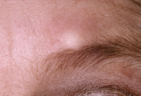 Hard Lump on Eyebrow