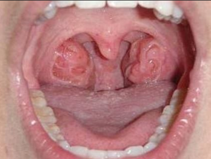 Holes in Tonsils