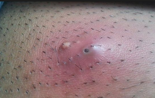 Ingrown Hair Cyst