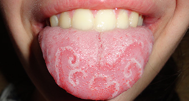 Itchy Tongue Possible Causes