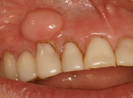 Lump on Gum Picture