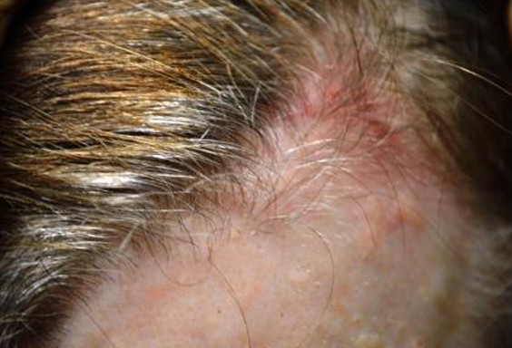 Pictures of Shingles on Scalp
