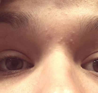 Pimple between Eyebrows