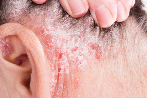 Rash Behind Ear Picture