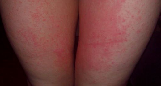Rash on Inner Thigh Picure