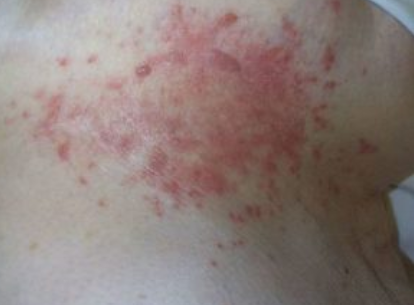 Rash under Breast could be yeast infection