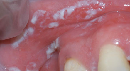 What Causes White Spots on Gums - Pictures