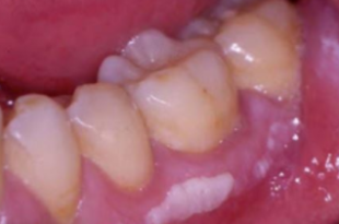 gums spot painful rid bumps hurts