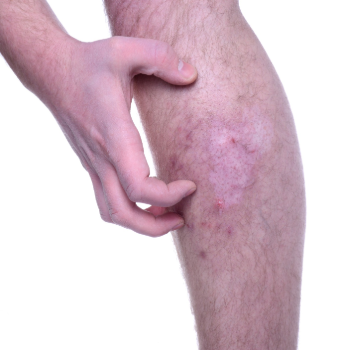 itchy lower Legs could be a sign of Diabetes